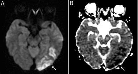 FULL TEXT - Stroke after blood patch in a patient with postpartum angiopathy and posterior ...