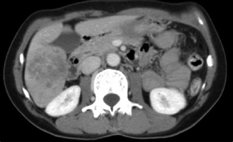 A. CT scan showing pre-treatment liver lesion of 5.0×4.5 cm. | Download ...