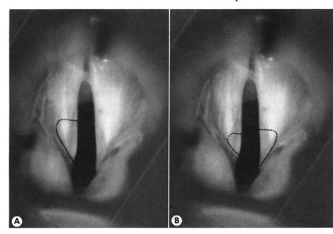 Figure 2 from Carbon Dioxide Laser Posterior Cordectomy for Treatment ...