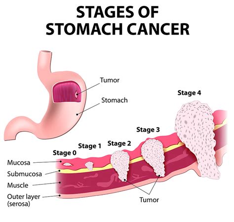 Stomach Cancer Treatment Bangalore | Surgery for Stomach Tumor