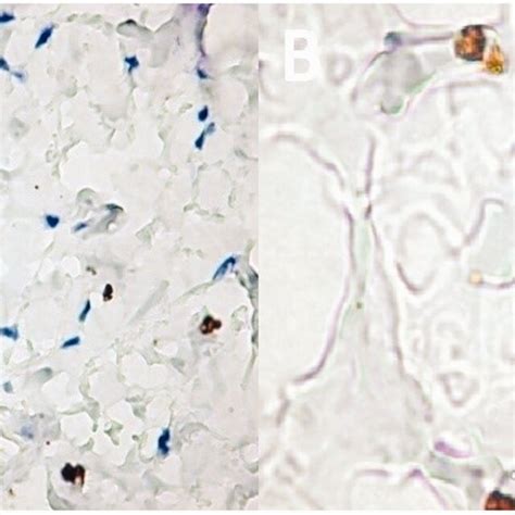 Combined vascular malformation–capillary–venous–lymphatic (12-year-old ...