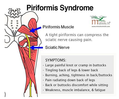 394 best male pelvic pain images on Pinterest