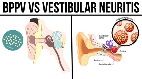 BPPV vs Vestibular Neuritis - YouTube