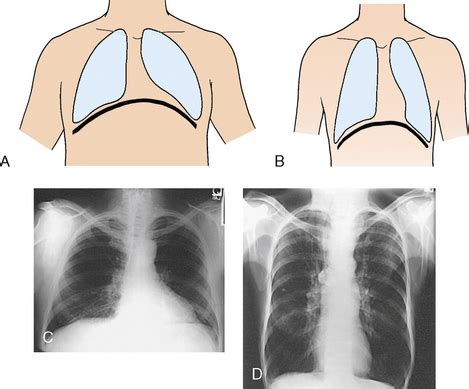 BONY THORAX | Radiology Key