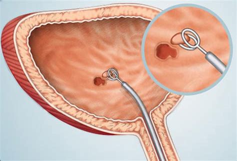 Bladder Cancer Symptoms