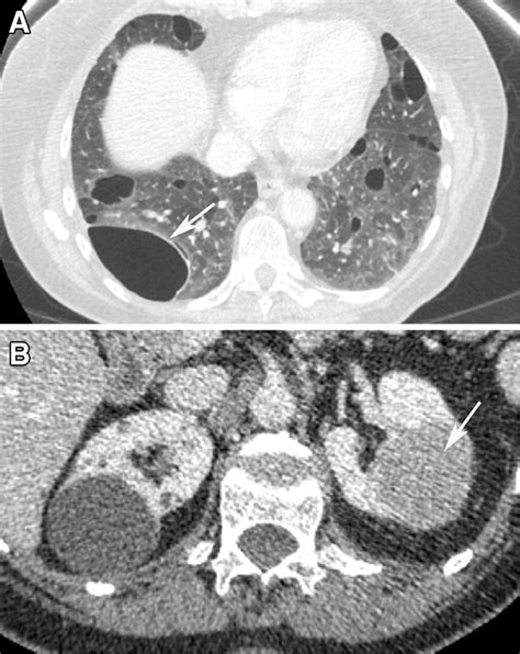 Birt–Hogg–Dube syndrome. A Axial CECT through the chest shows multiple ...