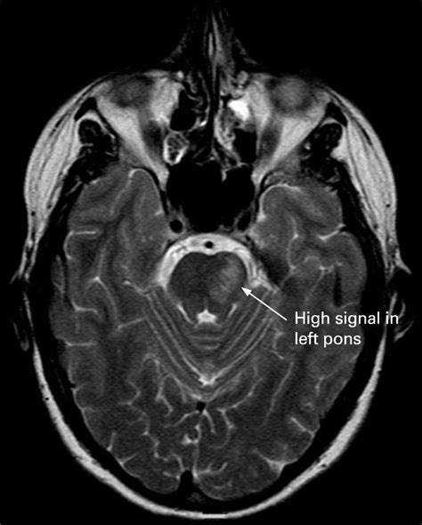 Pontine infarction due to intracranial venous thrombosis | Practical ...