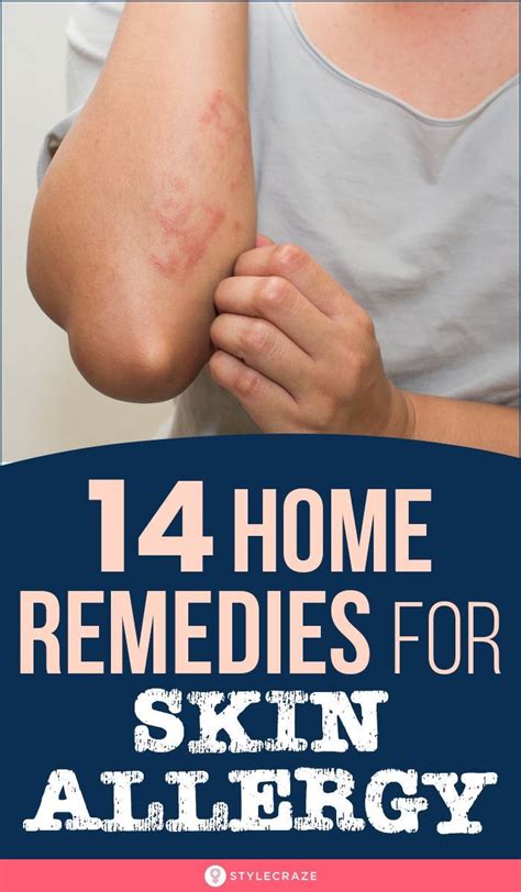 14 best home remedies for skin allergies – Artofit