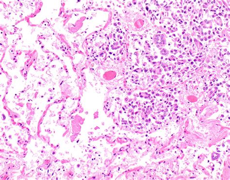 Epithelioid Mesothelioma Pathology Outlines - Goimages 411