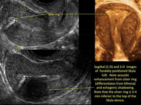 How to identify and localize IUDs on ultrasound | MDedge ObGyn