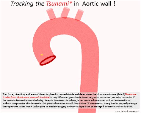 plane of aortic dissection | Dr.S.Venkatesan MD