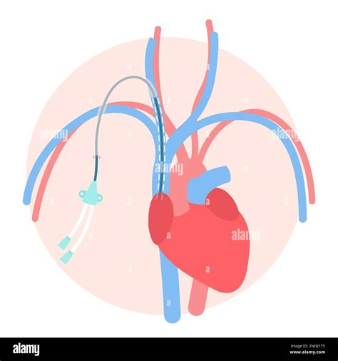 Tunneled central line venous catheter medical diagram Stock Vector Image & Art - Alamy