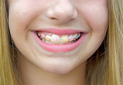 clear_braces_color_bands - Hardy Pediatric Dentistry & Orthodontics