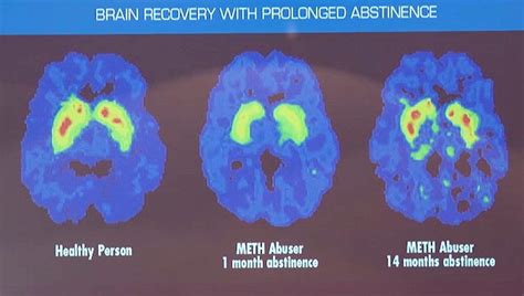 Ice - The effects of meth-induced dopamine on the brain by Prof McKetin