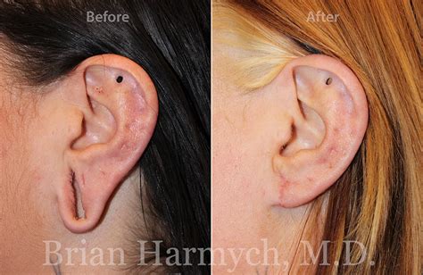 Earlobe Repair | Ear Surgery | Cleveland, OH