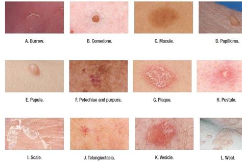 Types Of Skin Lesions Medical Addicts Terms Used To Describe Skin | My ...