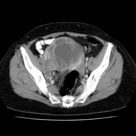 Endometrial carcinoma | Radiology Reference Article | Radiopaedia.org