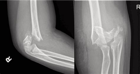 orthopedics - Supracondylar Fracture to the Humerus - Medical Sciences Stack Exchange