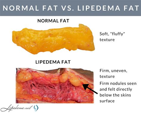 » Lipomatosis Nodules & Manual Extraction - Lipedema