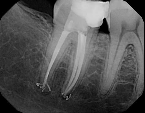 Apical-delta-post-op-1 from Micro Endodontics of Las Vegas in Las Vegas, NV 89129