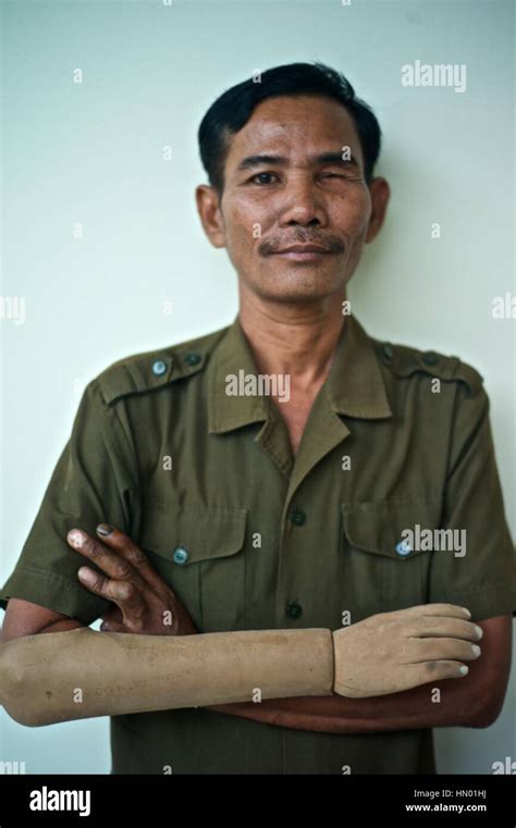 Model released portrait of a Cambodian land mine survivor, who lost one ...