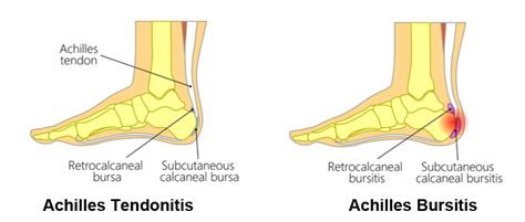 Achilles Bursitis: Symptoms, Causes, Treatment By Ankle Braces