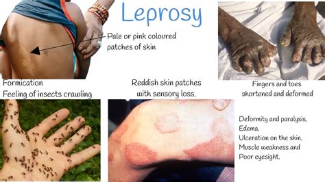 Leprosy Diagnosis and Treatment - FAQs