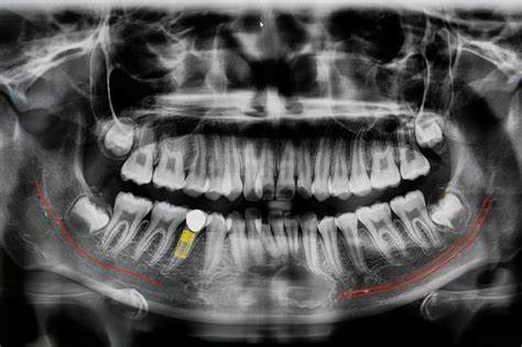 The Procedure, Types, and Need for Dental Bone Graft Surgery