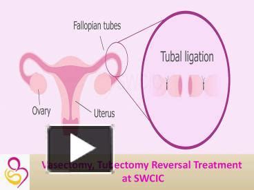 PPT – Vasectomy Tubectomy Reversal Treatment PowerPoint presentation | free to download - id ...