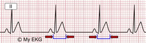 Hypocalcemia Ecg Changes