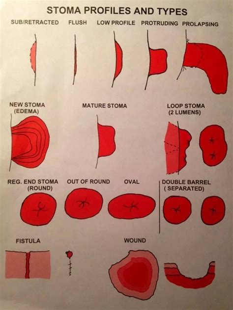 Stoma Types | nursing | Wounds nursing, Nursing board