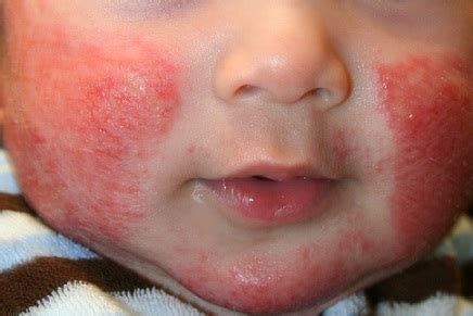 ECZEMA TREATMENT, CHILDREN WITH ECZEMA