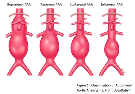 abdominal aortic aneurysm Archives - emdocs