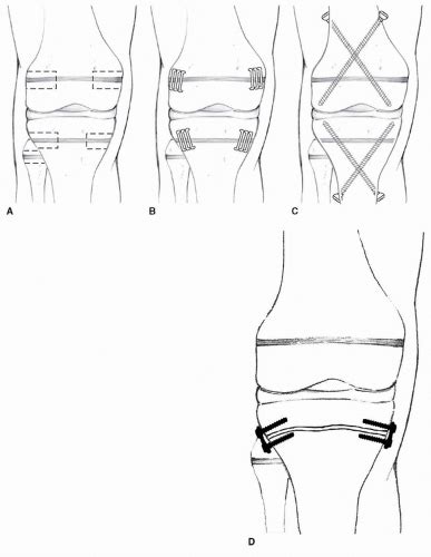 Epiphysiodesis | Musculoskeletal Key