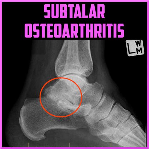 Subtalar Osteoarthritis - Sports Medicine Review