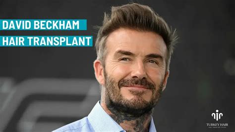 Unbelievably Story About David Beckham Hair Transplant 2023 | Turkey ...