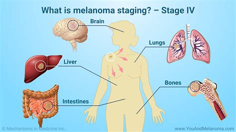 Slide Show - Understanding Melanoma