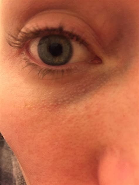 [skin concerns] what are these white bubbles/spots under my eyes? : r/SkincareAddiction