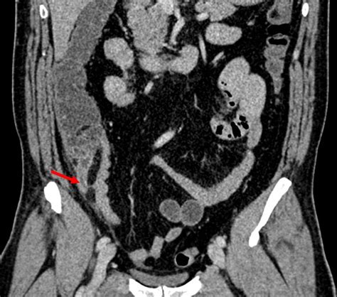 Acute appendicitis: subcaecal appendix – Radiology Cases