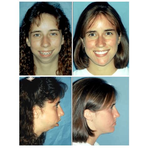 Before and After Photos Maxillofacial Surgery - Larry M. Wolford, DMD