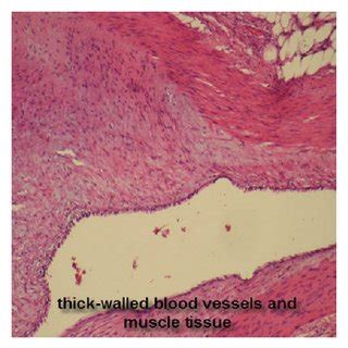 (PDF) A Bladder Wall Angiomyolipoma as a Manifestation of Tuberous ...