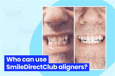 SmileDirectClub - Are Their Aligners Worth It? - Aligners