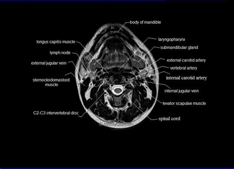 MRI neck anatomy | free MRI axial neck cross sectional anatomy | Mri, Vertebral artery ...