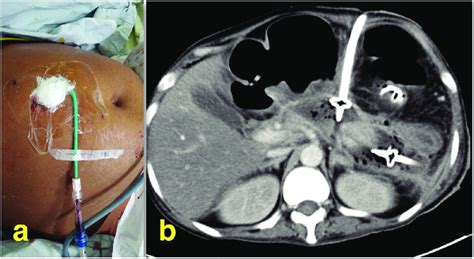 Percutaneous catheter drainage: a) clinical image depicting... | Download Scientific Diagram