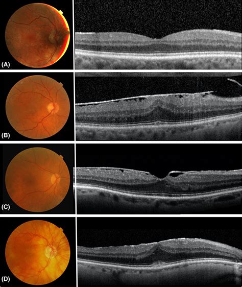 Prevalence of epiretinal membranes in the ageing population using ...