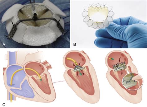 Percutaneous Approach to Pericardial Window | Thoracic Key