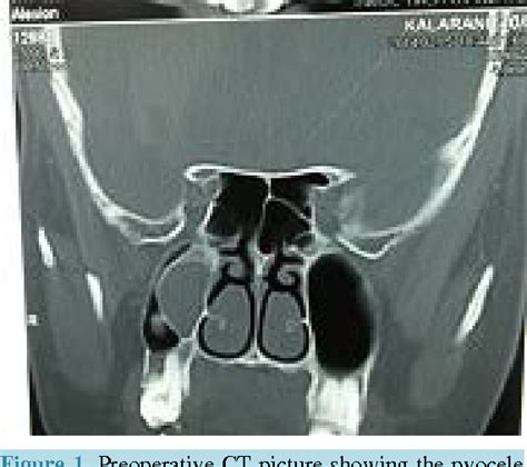 Figure 1 from A Loculated Pyocele of Maxillary Sinus—A Rare Case Report ...