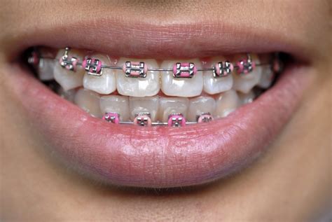 Coloured Braces in Surrey | Guildford Orthodontic Centre