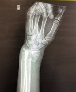 Smith’s Fracture Diagnosis and Management | Resus