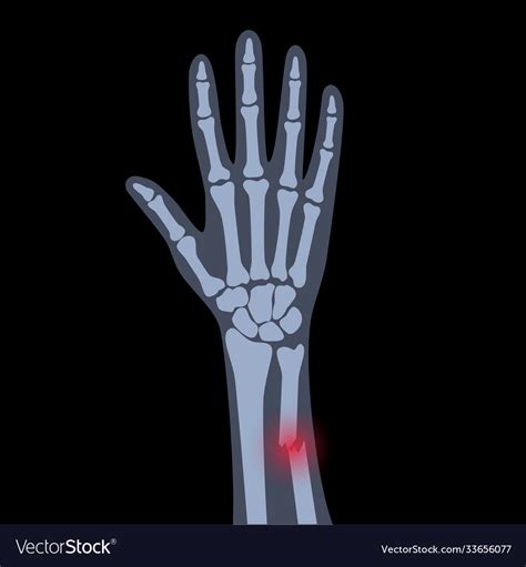 Fracture x ray concept Royalty Free Vector Image